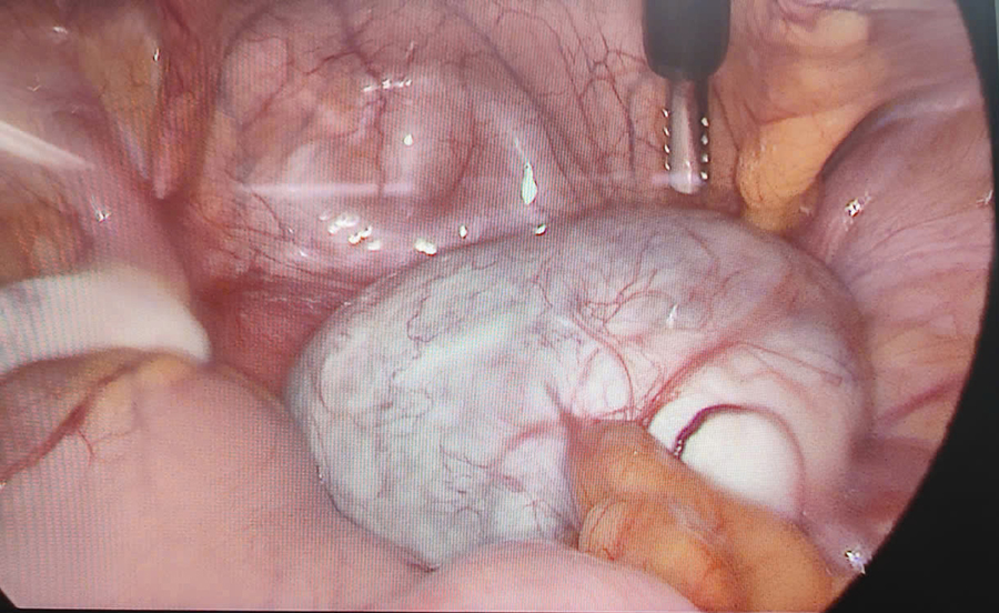 Phẫu thuật thành công khối u nang buồng trứng "khủng" cho thiếu nữ 18 tuổi